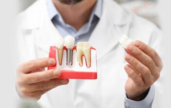 Smile Makeover 101: How Dental Implants Transform Your Confidence