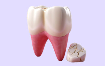 Does a Cracked Tooth Need to Be Pulled? Understanding Your Options