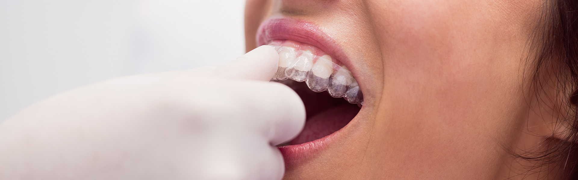 Which Teeth Does Invisalign Move First? A Step-by-Step Guide