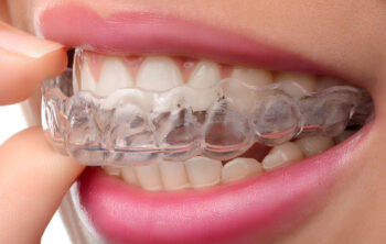 How Long Does Invisalign Take? Your Timeline Explained