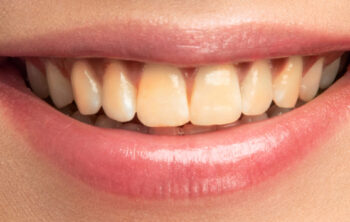 My Teeth Are Yellow: How to Make Them White with Whitening Treatments