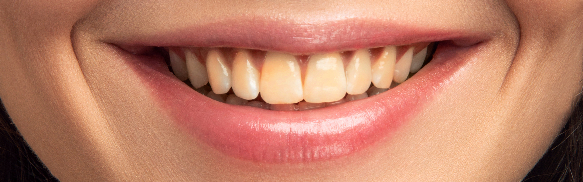 My Teeth Are Yellow: How to Make Them White with Whitening Treatments